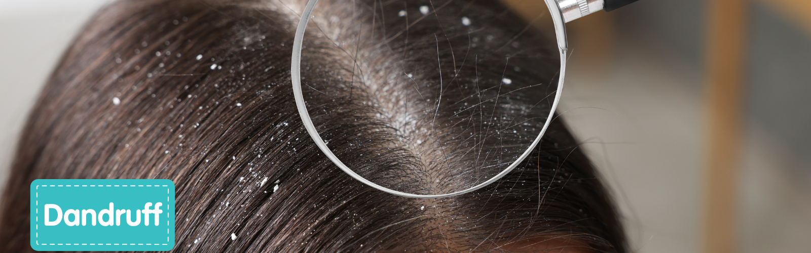 Dandruff